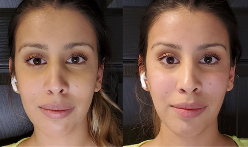 Face Filler Before After Mississauga Oakville